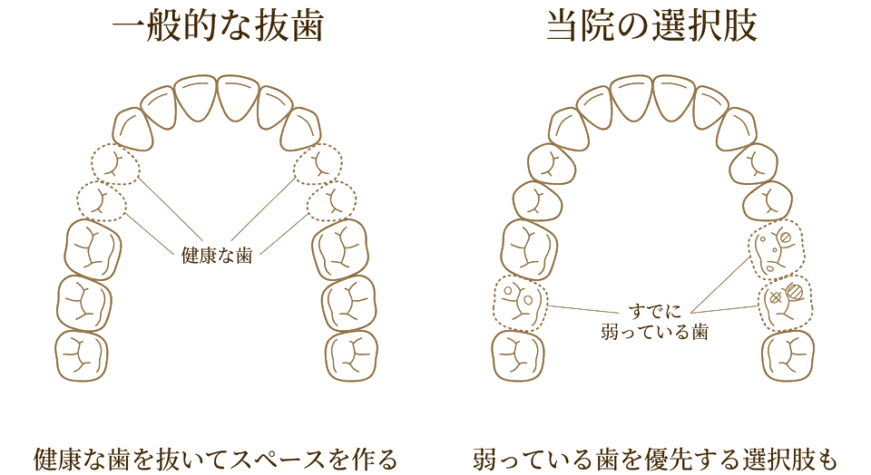一般的な抜歯（健康な歯を抜く）と当院の選択肢（すでに弱っている歯を優先する）の比較図