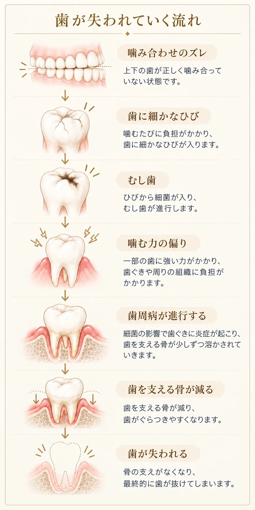 歯が失われていく流れ:噛み合わせのズレ、歯に細かなひび、むし歯、噛む力の偏り、歯周病の進行、歯を支える骨が減る、歯が失われる