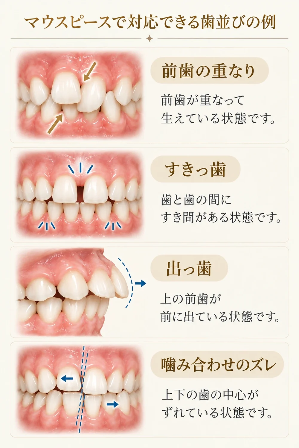 マウスピースで対応できる歯並びの例：前歯の重なり、すきっ歯、出っ歯、噛み合わせのズレ